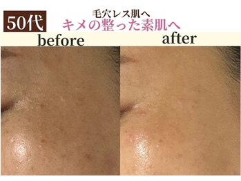 パールホワイトニング/50代 毛穴改善