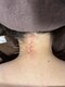 ビーフラット(B-flat)の写真/首肩こり解消！気になる巻き肩や挙がらない腕・ストレートネックもそこだ！というところに鍼の刺激が届く☆