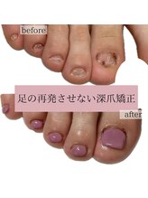 ティアラネイル(tiaranail)/足の再発させない深爪矯正