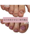 足の再発させない深爪矯正