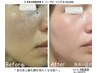【 本気の肌質改善 】 ハーブピーリング ¥ 22,000