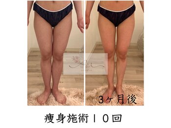 アイ エステサロン(Ai)/【30代産後ダイエット】美脚に