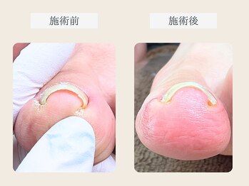 ルポ 伊勢/巻き爪ケア