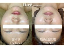 【肌質改善専門サロン】お悩みにあったメニューをご提案します♪