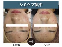 シアラ(SHIARA)/シミケア後の変化