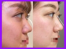 ハーブピーリング 名古屋/韓国肌・艶肌目指したい方必見！