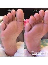 タコやウオノメなども除去。