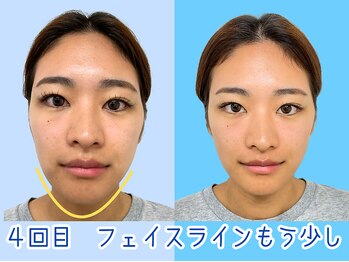 ナチュラルビューティーフェイス 横浜(NBF)/４回目小顔矯正/顔の歪み