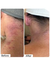 エミレーブ シロカネ(Hemireve Shirokane)/ずっと悩んでいたお肌の改善