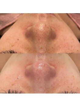 ミューズ(MUSE)/毛穴エクストラクション＋顔脱毛