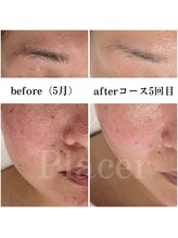 プラセル(Placer)/何をしても変わらなかった開き