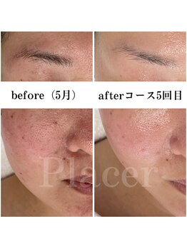 プラセル(Placer)/何をしても変わらなかった開き