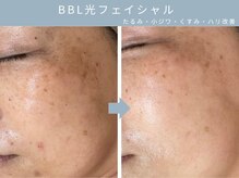 【たるみケア・シワケア・くすみケア・ハリ改善】30代以上におすすめ