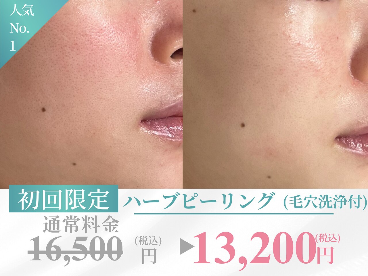 【毛穴☆人気No1】ハーブピーリング＋毛穴洗浄デコルテ付120分\16500→\13200