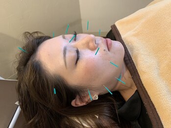 翼ツバサ整骨院の写真/【美容鍼が初めての方にオススメ☆】お顔の歪みを整え、むくみ・たるみ改善♪ほうれい線のケアにも◎¥2200