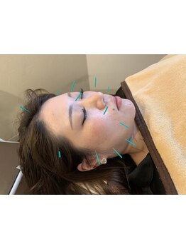 鍼灸施術を受けたい