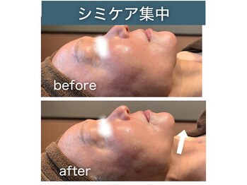 シアラ(SHIARA)/シミケア後の変化