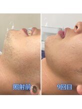 ナウザ 高崎店(NAUZA)/美容効果のある脱毛が行えます！