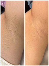 リラキュート(Rela Cute)/脇脱毛