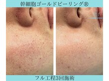 リメイククリニカルビューティー(Remake clinical beauty)/開き毛穴の深さも