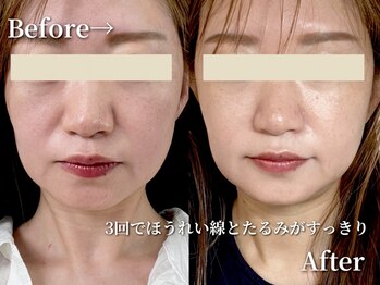 シャインアン(Shine'an)の写真/最短で最大の結果へ♪たるみ、もたつき知らずの若々しい顔に！10年後の自分を好きでいるため今始めよう！