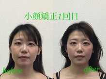 オズ六本木/小顔矯正モニター募集中！