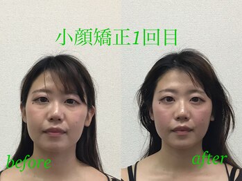 オズ六本木/小顔矯正モニター募集中!