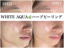 アワピール 天王寺店(AWA PEELL)/ハーブピーリング/ニキビケア