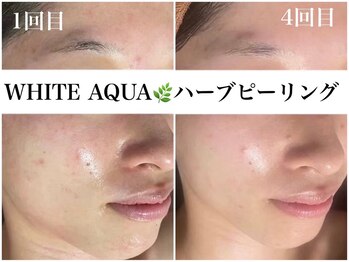 アワピール 天王寺店(AWA PEELL)/ハーブピーリング/ニキビケア