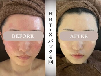 モルティー 宇都宮東店(Molti)/肌質改善/引き締め/小顔矯正/BTX