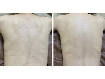 エト(eto.)の写真/背中ニキビケア、毛穴ケア、敏感肌にお悩みの方をハーブピーリングで改善に導く肌質改善特化サロン◎