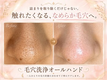 ウー 上熊本(WOO)/【毛穴黒ずみ】毛穴洗浄
