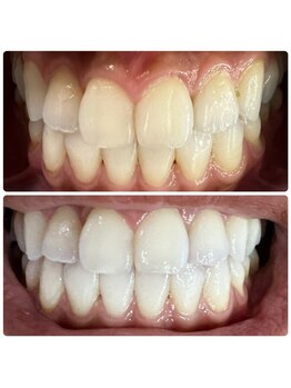 ラブホワイトニング 渋谷店(LOVEホワイトニング)/初回6回照射ホワイトニング