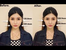ゆうき式小顔矯正/小顔矯正before＆after