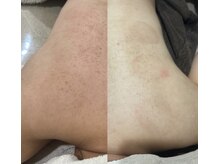 インク(ink)/背中スノーピーリング