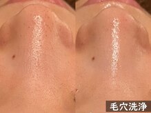 ココモンド(COCOMONDO)/ハイドロ毛穴洗浄/毛穴/毛穴洗浄