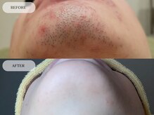 メンズプラス(MEN’S PLUS)/ヒゲ脱毛/ビフォーアフター写真
