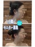 予約殺到【結果出し小顔モニター5月限】高周波リフト×コルギ/初回特典炭酸P