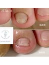 フットケア　巻き爪矯正