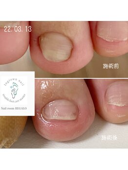 フットケア　巻き爪矯正