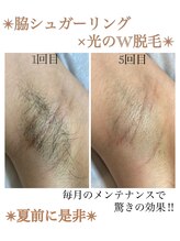 マベル シュガーリング(Mabelle)/脇のW脱毛