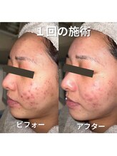 リファラ 光の森店(REFALA)/ハーブピーリング1回の効果