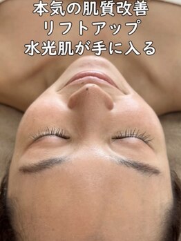 マヴィ 香里園店(MavY.)/ノンニードル水光注入の秘密