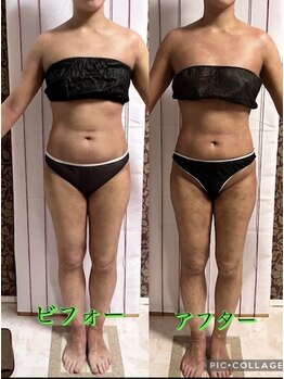 アコラージュ/レモンボトル/小顔/ブライダル