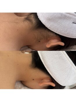 ナビ ビューティー(NABI Beauty)/【うなじ脱毛】