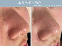 【毛穴ケア】水素水で毛穴詰まりスッキリきれいに