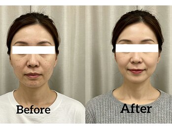 なごやの森/小顔・輪郭矯正ビフォーアフター