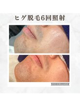 ボゴス(BOGOSS)/ヒゲ6回照射