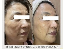 アンソレイエ(ENSOLEILLE)/医師提携肌改善プログラム　ADS