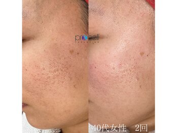 オウジエステサロン(OJIエステサロン)/40代女性　プロセル2回